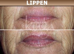Der Farbkontrast zwischen Lippen und Gesichtshaut nimmt ab, je älter man wird (oben). Mit einer exakten Kontur und einem natürlich wirkenden, kräftigeren Farbton werden die Lippen klar von der Gesichtshaut abgegrenzt (unten).
